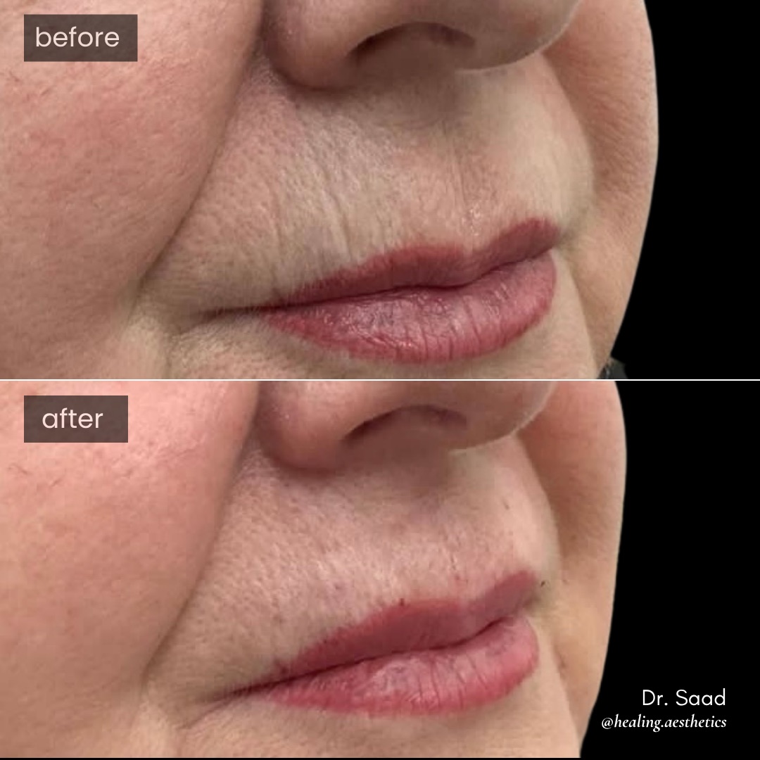 Before and after Smoker's Lines Solution — vertical lip lines relaxed and filled, actual patient of Dr. Saad