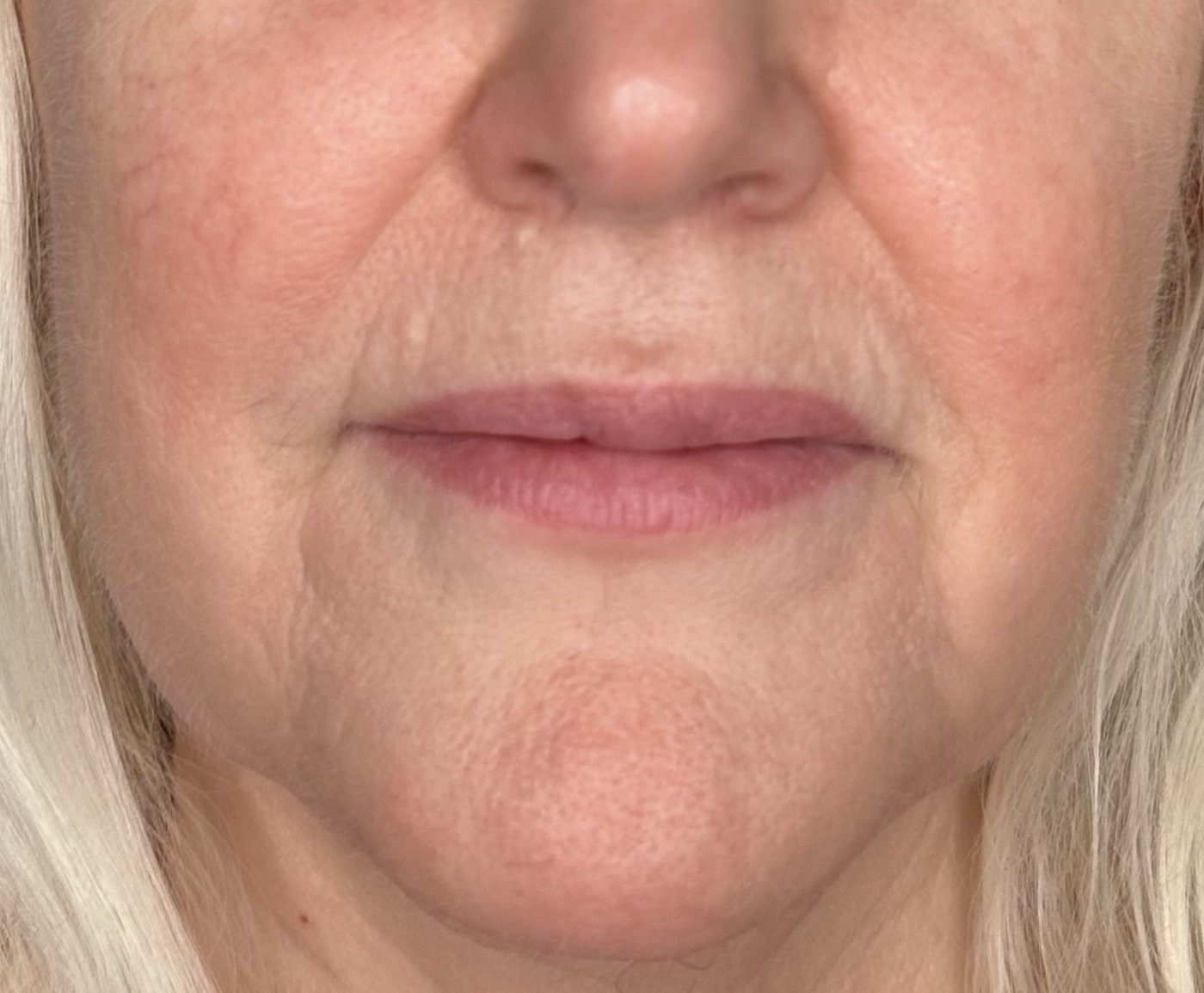 Close-up of a patient's lower face showing marionette lines before treatment