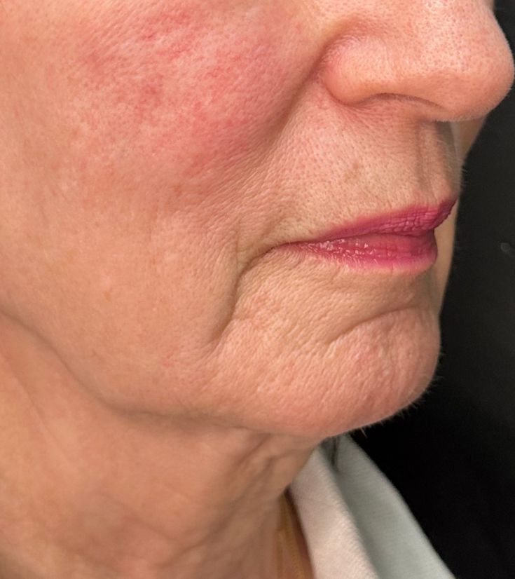 Side view of a patient's lower face with the marionette line circled — the crease running from the corner of the mouth toward the chin