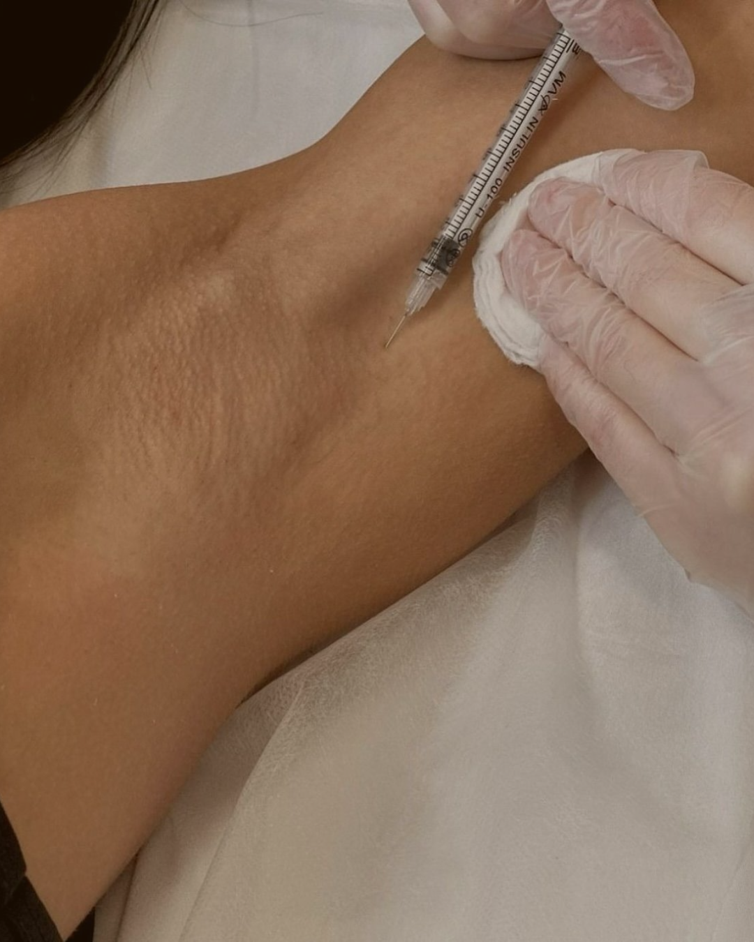 Botox for excessive sweating hyperhidrosis — underarm treatment Hinsdale IL