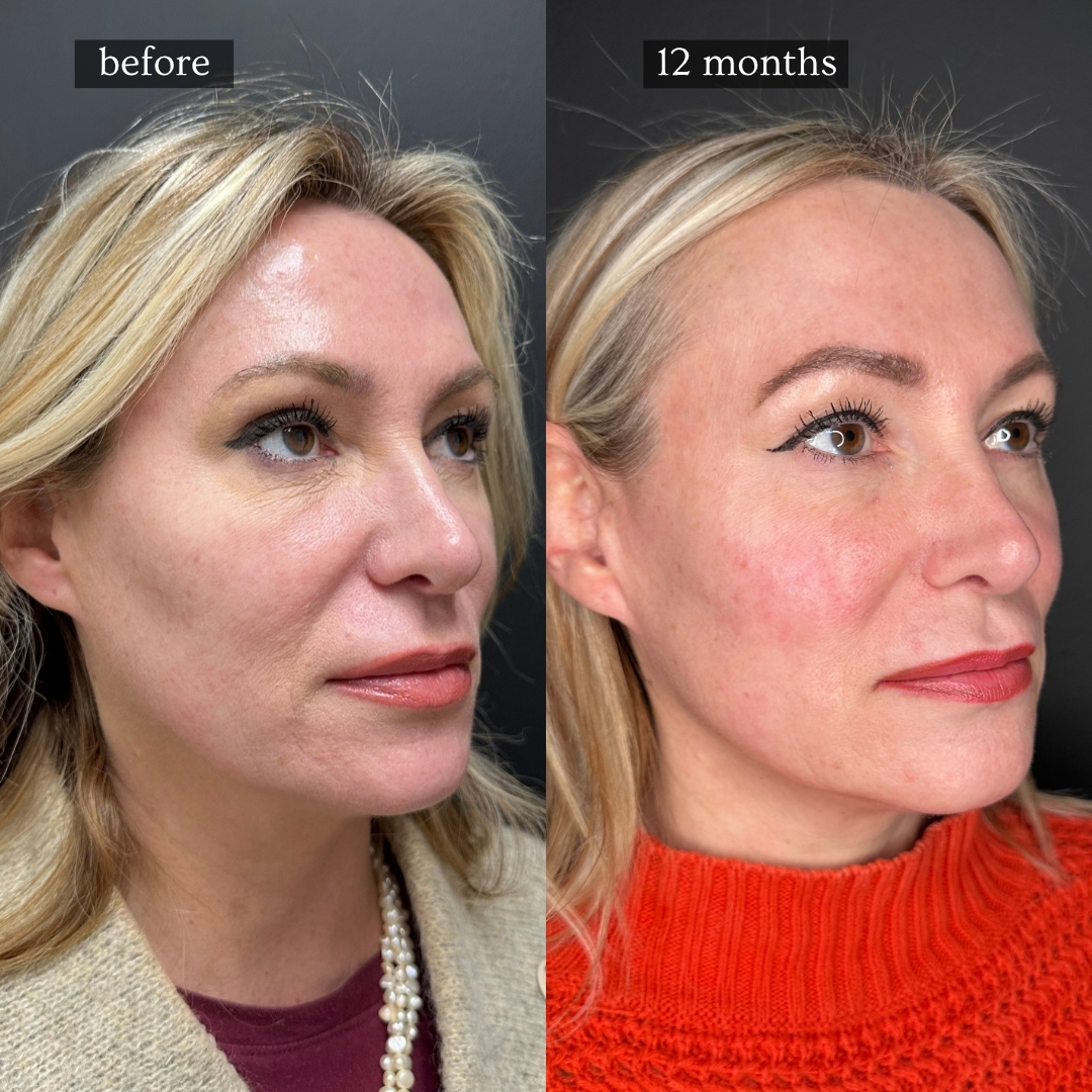 Sculptra before and after — facial volume restored at 12 months, Hinsdale IL