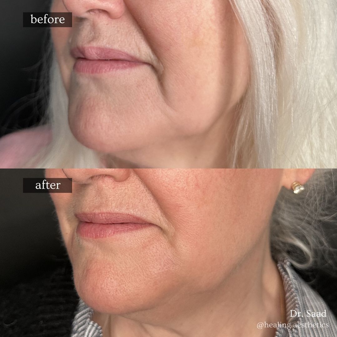 Before and after — Radiesse for marionette lines, actual patient of Dr. Saad at Healing Aesthetics, Hinsdale IL