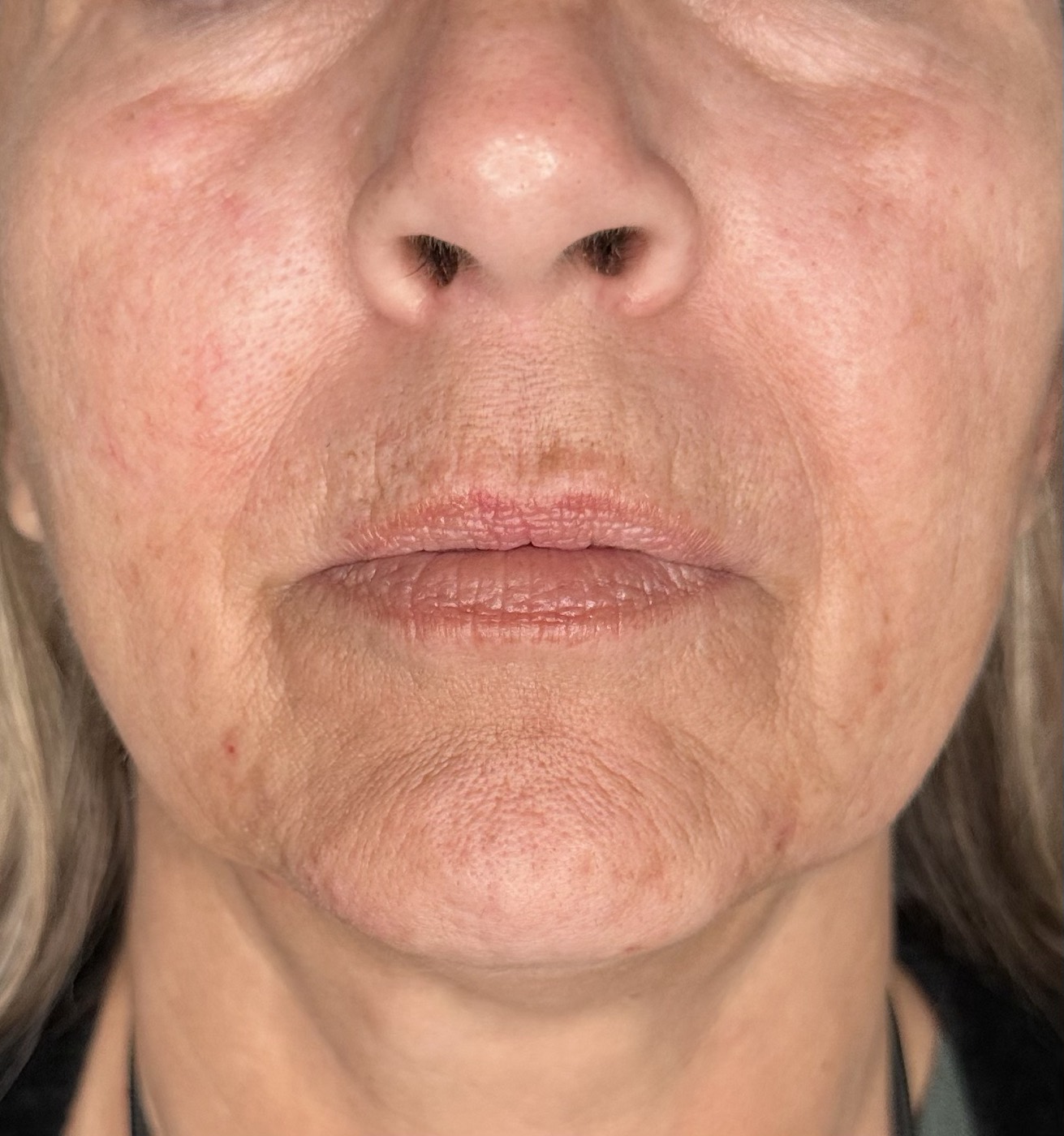 Close-up of marionette lines and downturned mouth corners on a patient of Dr. Saad at Healing Aesthetics, Hinsdale IL