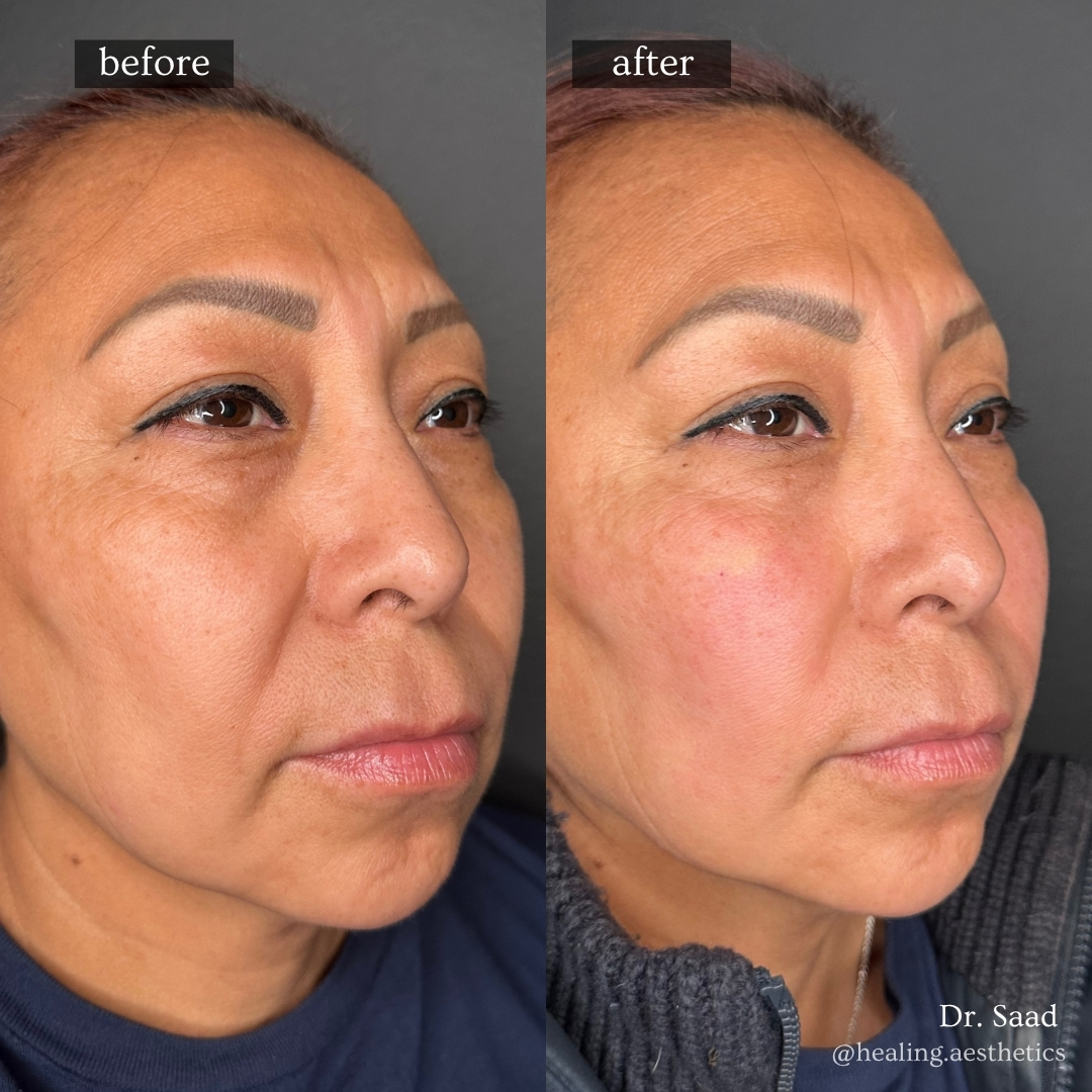 PRF nasolabial fold and cheek rejuvenation before and after at Healing Aesthetics Hinsdale IL