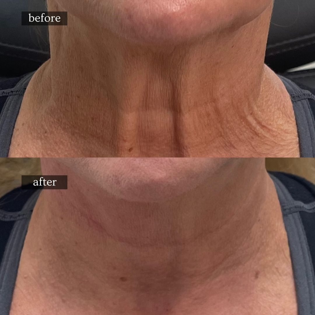 Before and after Botox treatment of platysmal neck bands
