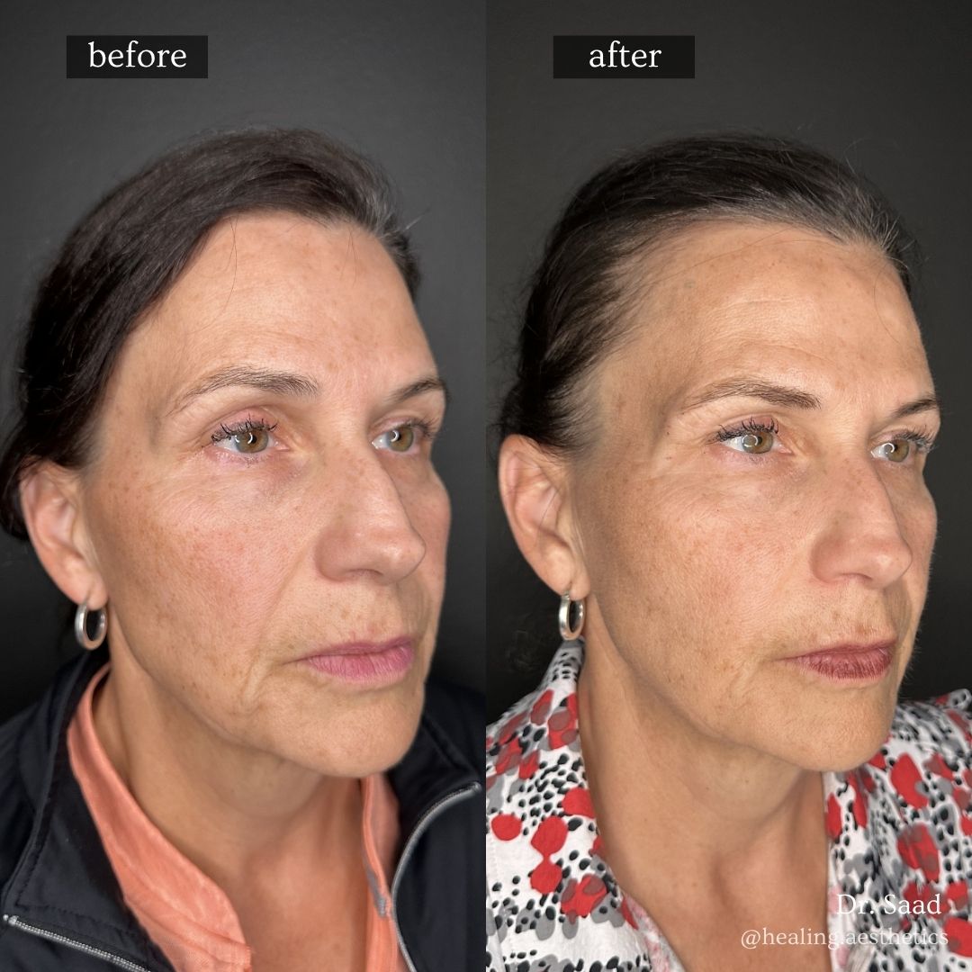 Sculptra before and after — collagen restoration and firmer skin, Hinsdale IL