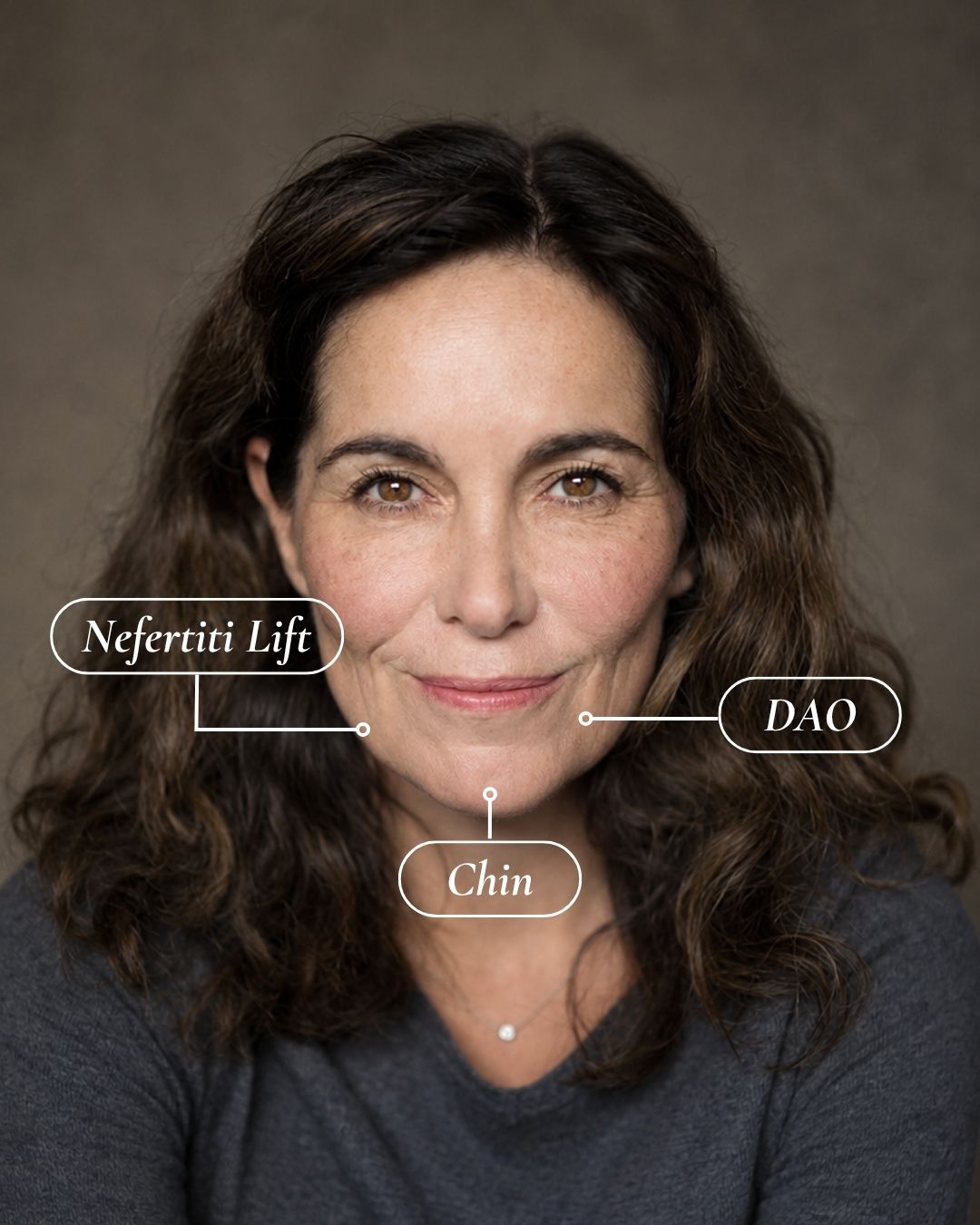 Lower-face treatment areas mapped on a face — Nefertiti lift along the jawline, DAO at the corners of the mouth, and the chin