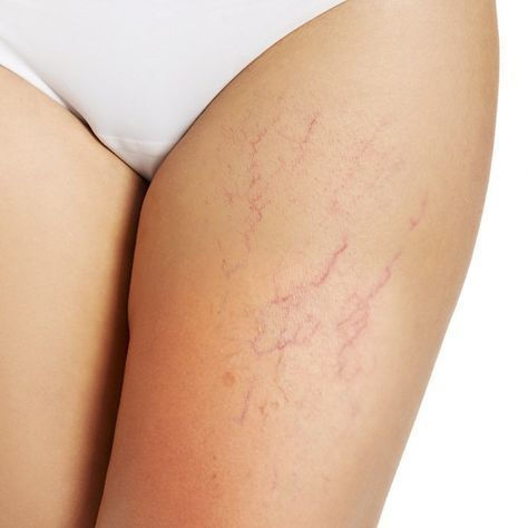 Spider Vein treatment at Healing Aesthetics