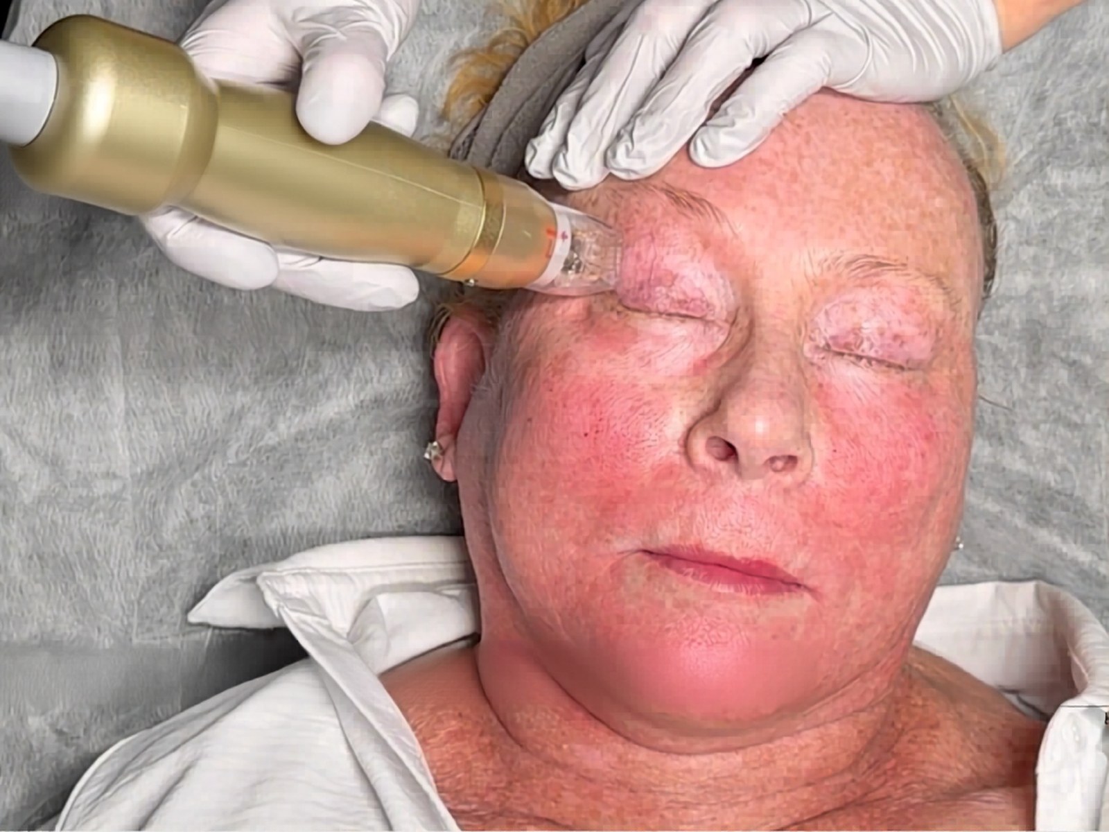 Sylfirm X RF microneedling at Healing Aesthetics