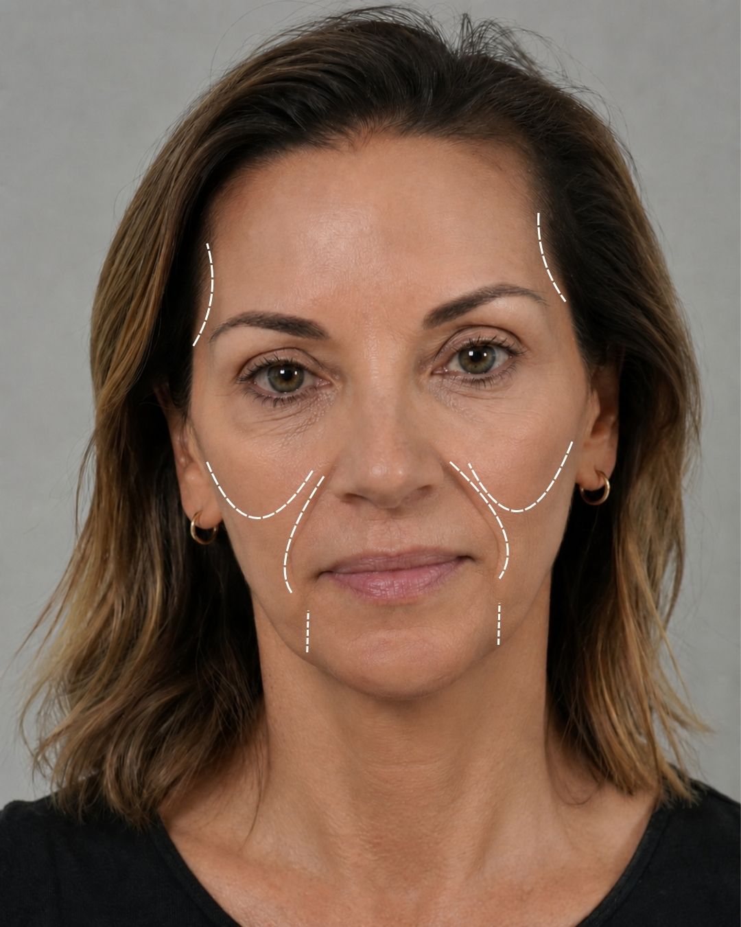 Biostimulant facial contouring — cheeks, smile lines, temples