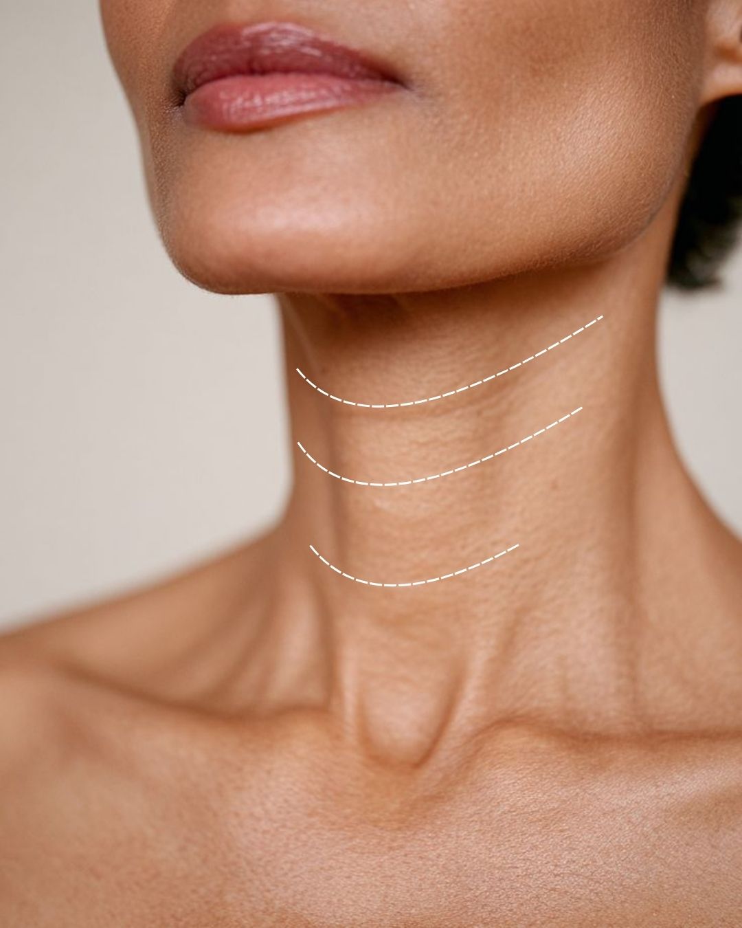 Biostimulant neck rejuvenation — laxity and horizontal lines