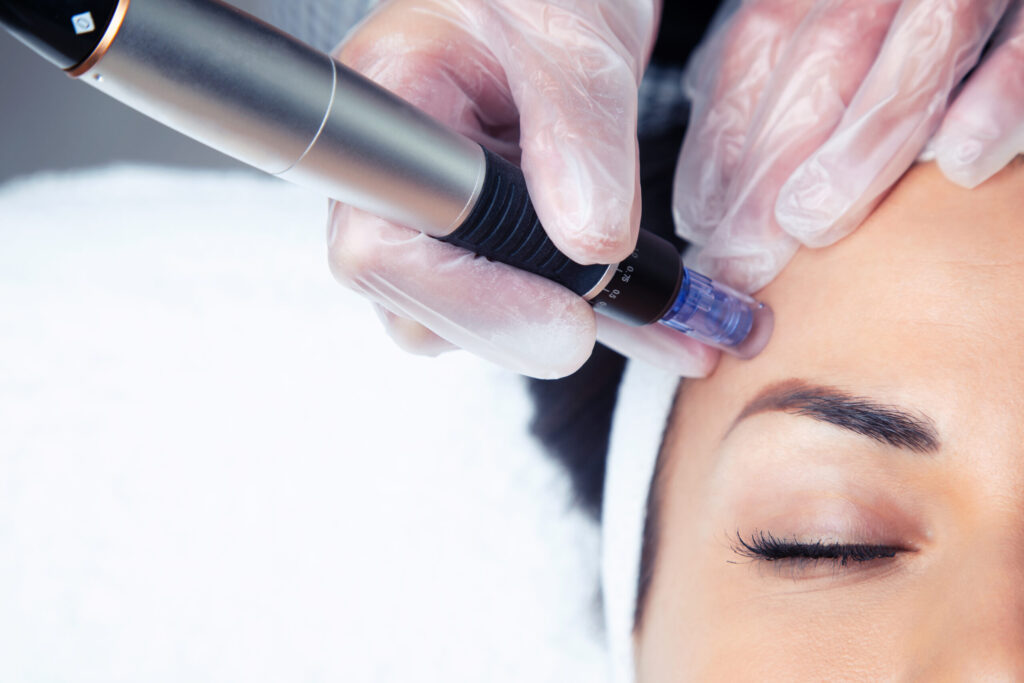 MICRONEEDLING