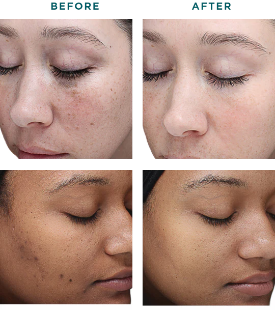 Chemical Peel VI Peel