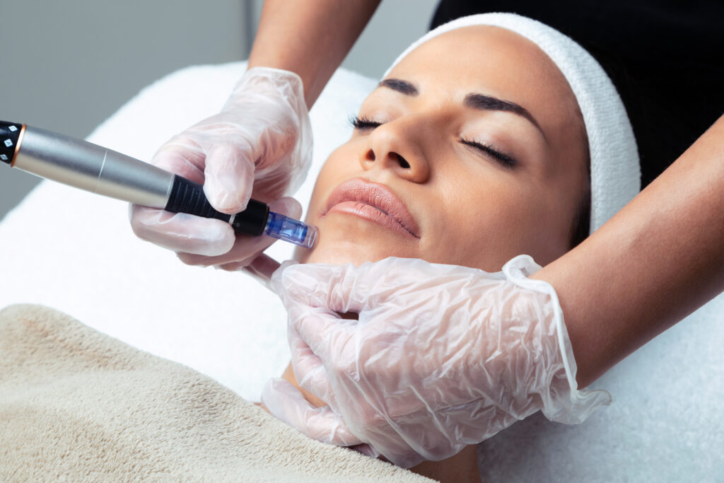 microneedling